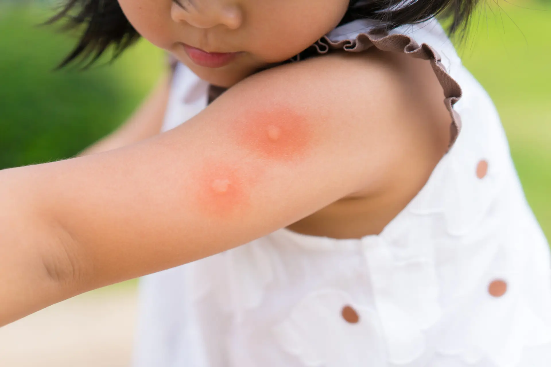 young girl with mosquito bites on her arm